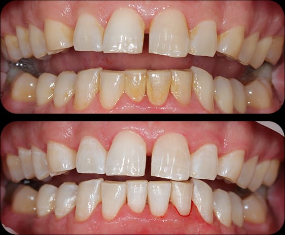 EMS before and after 2