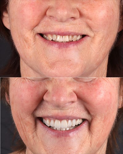 Veneers Smile Makeover 4