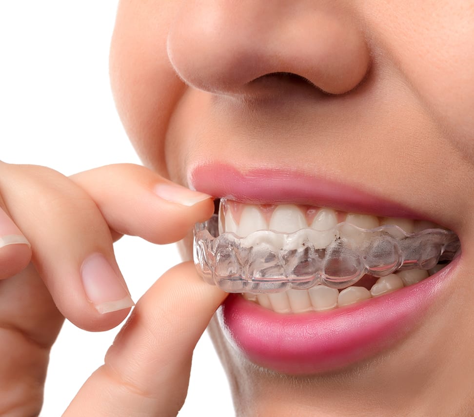 invisalign