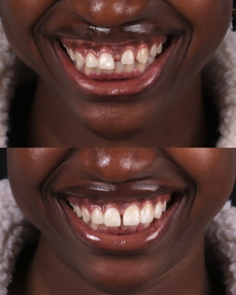 SVL before after 11