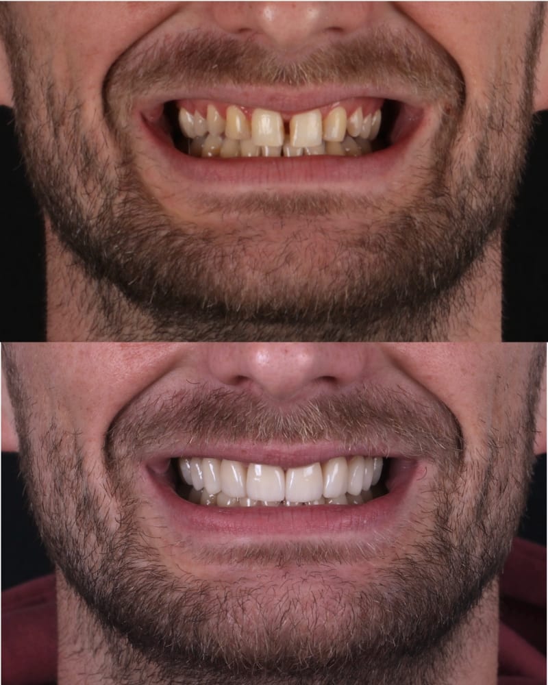 SVL before after 13