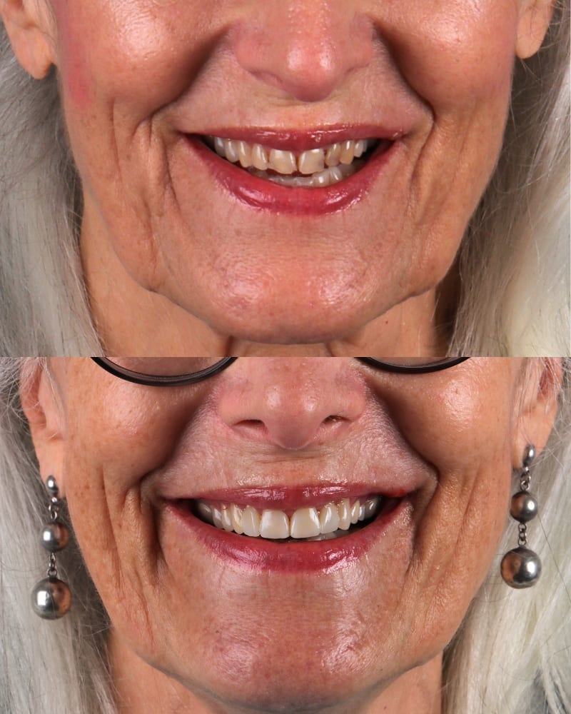 SVL before after 15