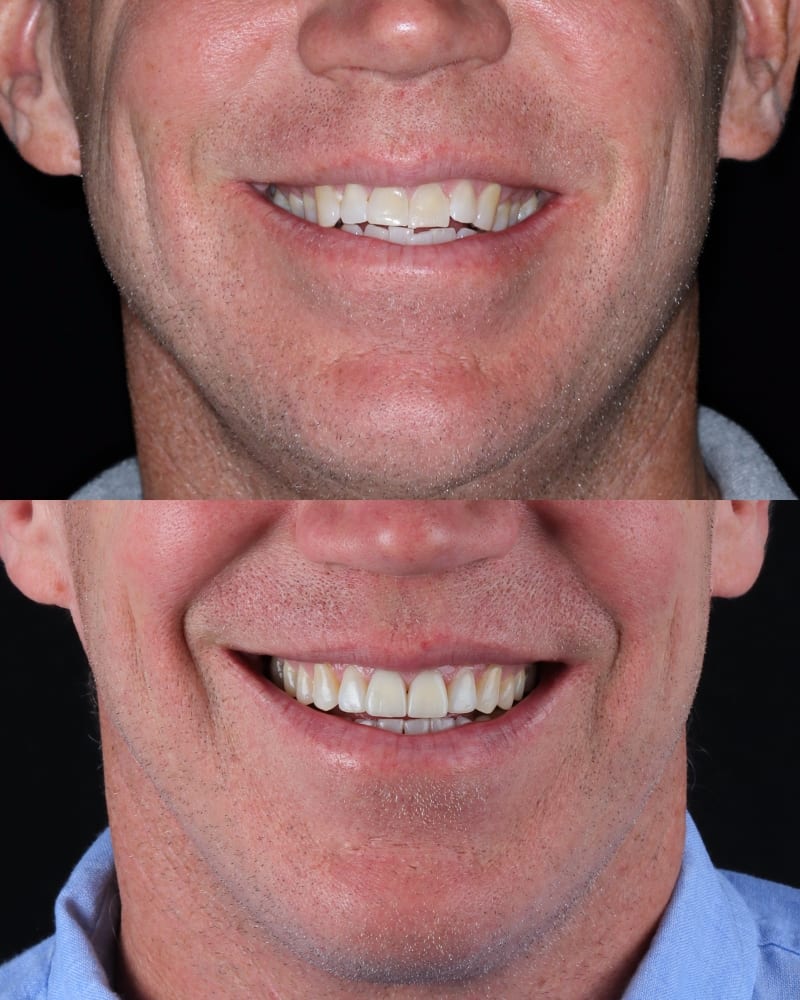 SVL before after 17