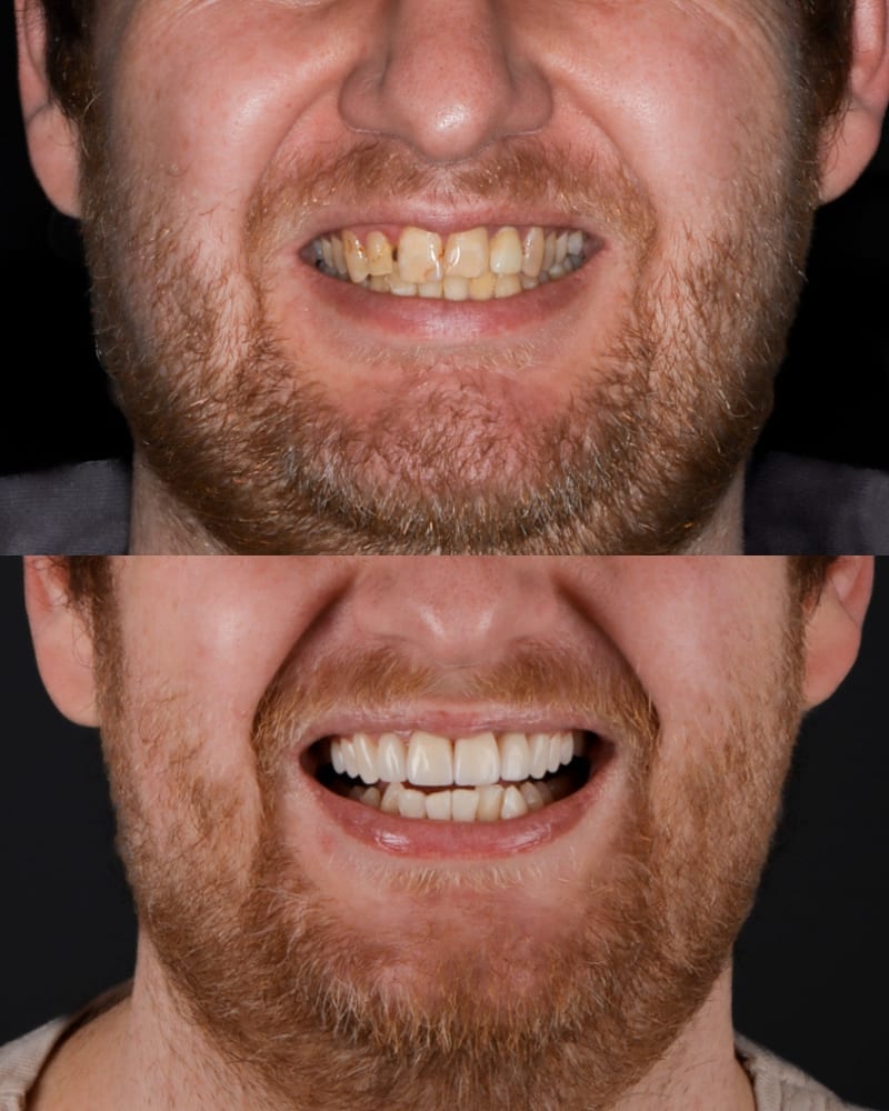 SVL before after 18