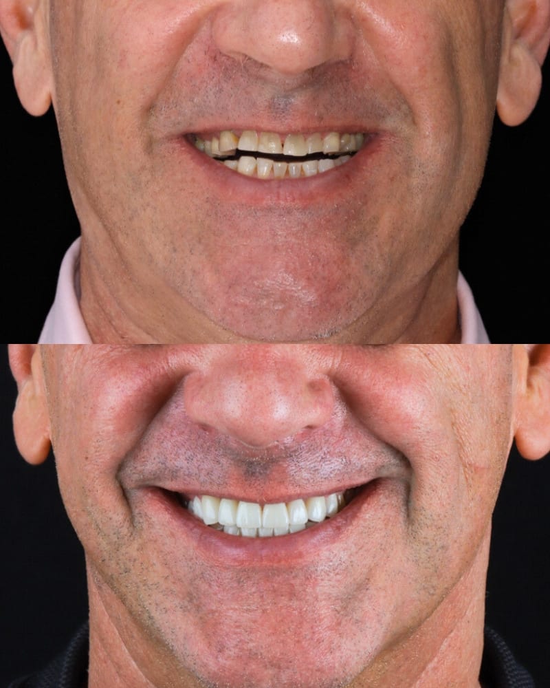 SVL before after 19