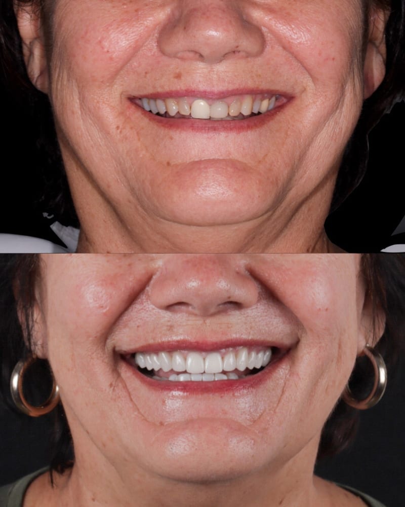 SVL before after 21