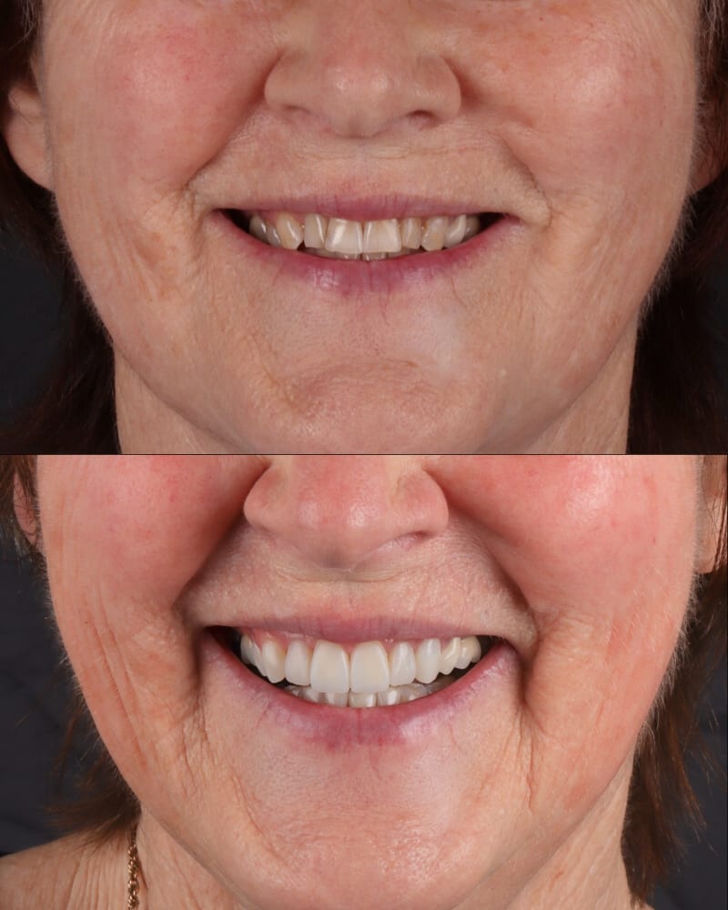 SVL before after 22