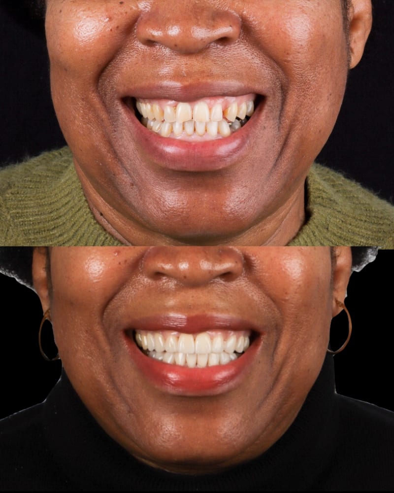 SVL before after 26