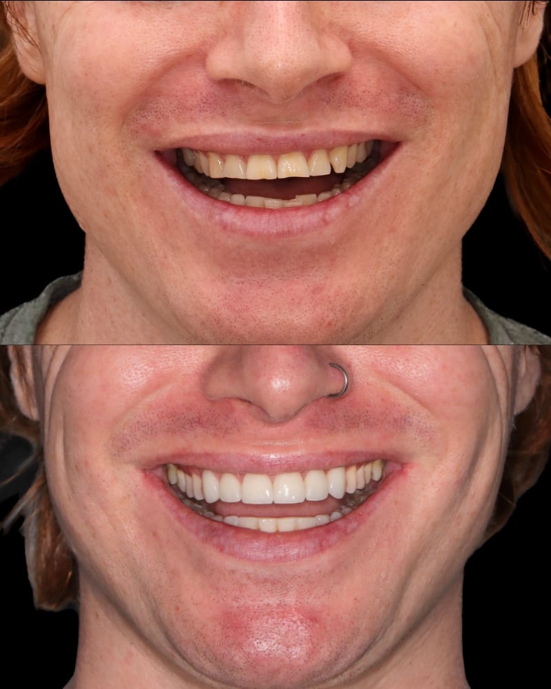 SVL before after 27