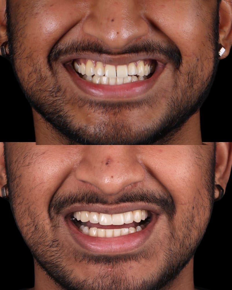 SVL before after 2