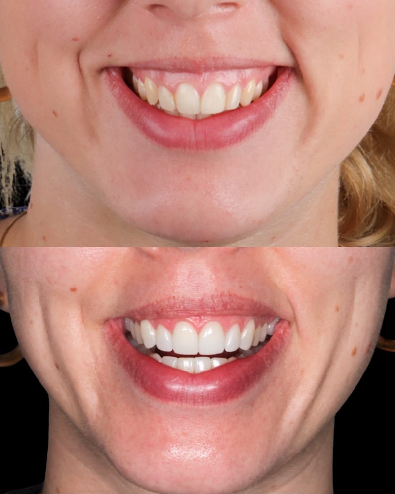 SVL before after 31