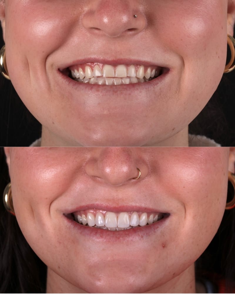 SVL before after 4