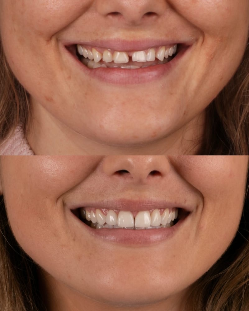 SVL before after 5