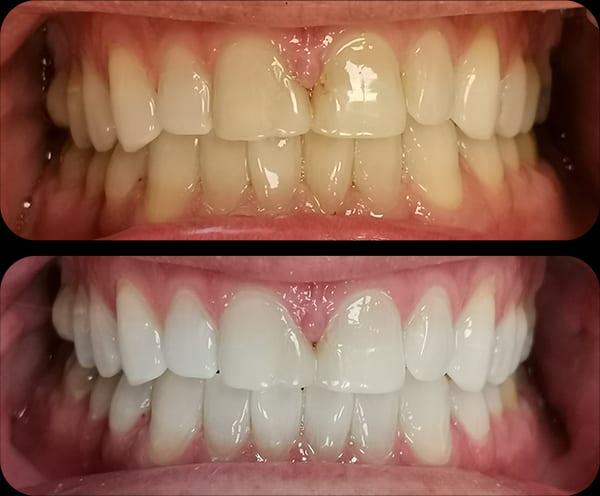 Whitening Before and After 1