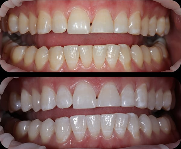 Whitening Before and After 3